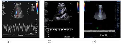 Hepatic and portal vein Doppler ultrasounds in assessing liver inflammation and fibrosis in chronic HBV infection with a normal ALT level